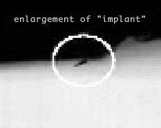 Alien Implant Alien Implant